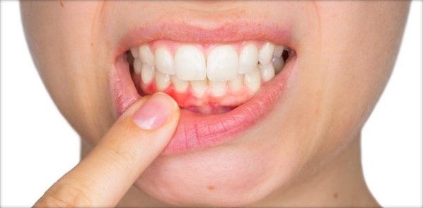 Bleeding Gums Symptoms